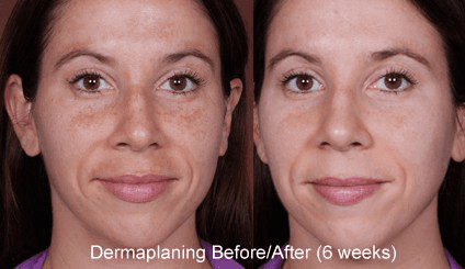 Dermaplanning before and after