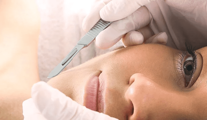 what is dermaplaning facial